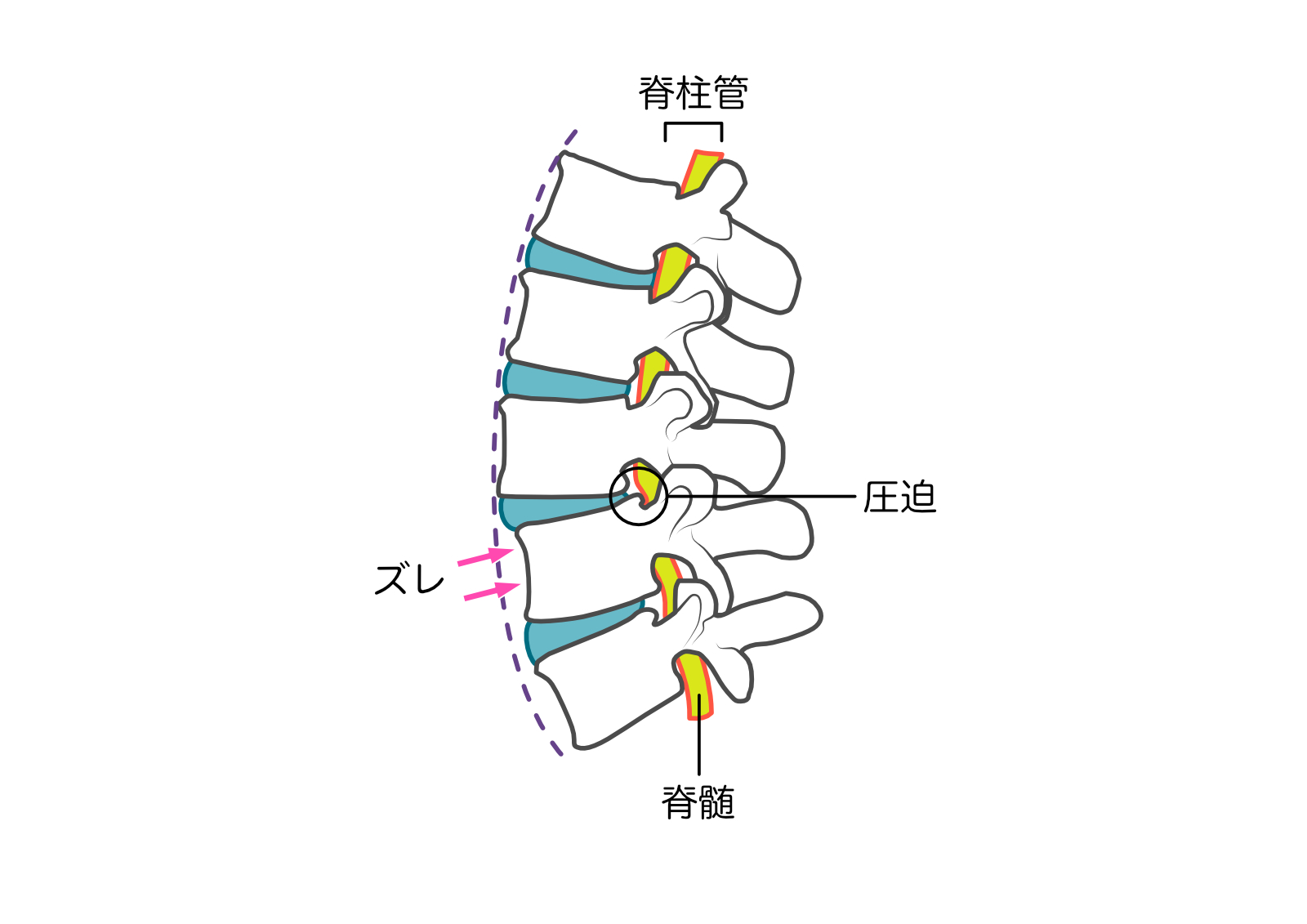 すべり症のイメージ